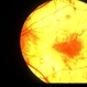 Choroidal atrophy, probable choroideremia Choroidal atrophy, probable choroideremia